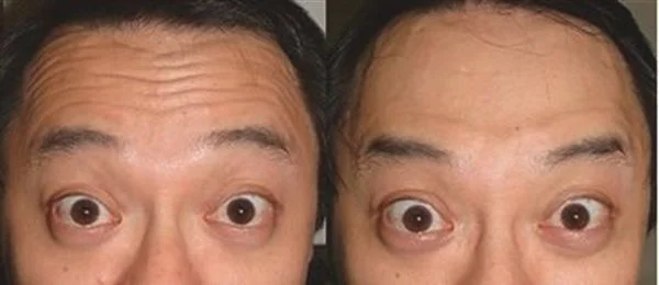 激光去除抬头纹维持时间是多久？