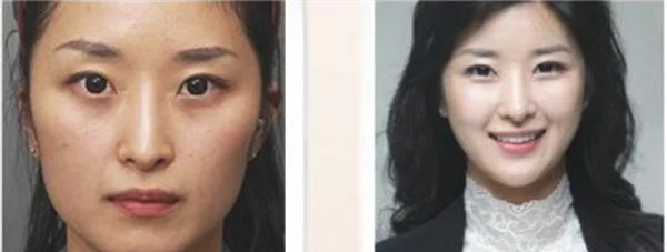 做激光祛斑治疗效果怎么样？效果保持时间多久？