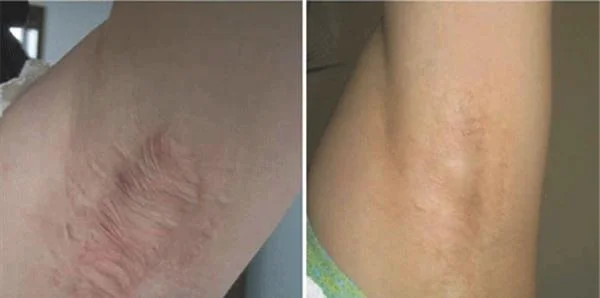 做祛疤价格是多少