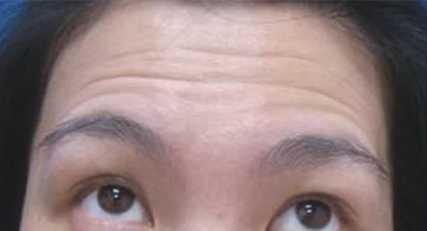 做自体脂肪去抬头纹手术注意事项是什么？