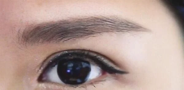 E光去鱼尾纹手术术后护理？
