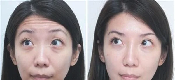 做射频去抬头纹费用大概需要多少