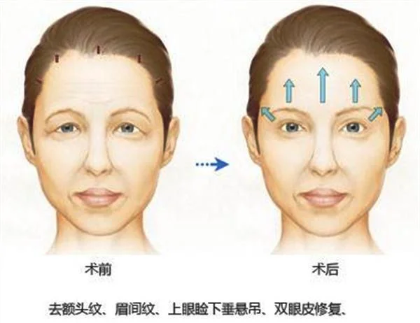 额颞部除皱去抬头纹手术安全吗？