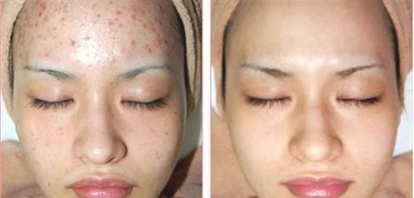针清祛痘怎么护理?