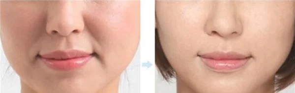 做胶原蛋白去法令纹手术多少钱？