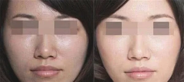 做E光嫩肤治疗效果怎么样？效果保持时间多久？
