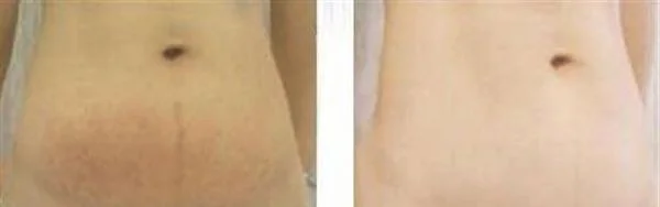 激光去妊娠纹手术的方法是什么？