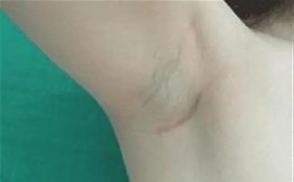 做冷冻法去腋臭手术多少钱？