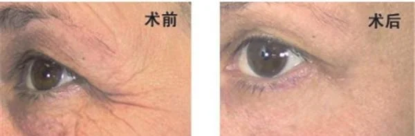 小切口除皱去鱼尾纹有副作用吗？