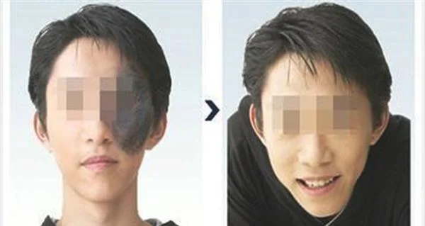 做光子治疗太田痣费用要多少