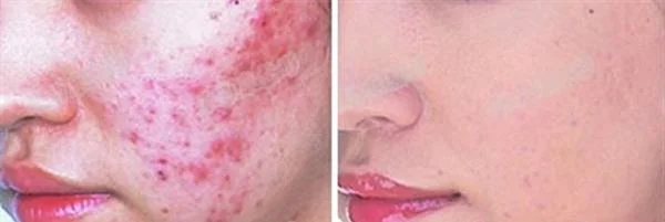 红蓝光祛痘手术安全吗?