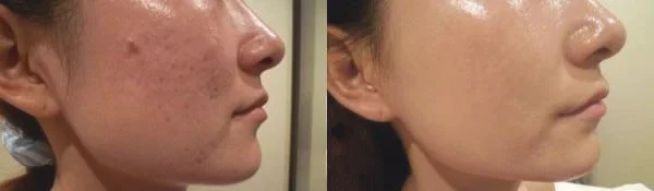 做光子去痘印费用要多少