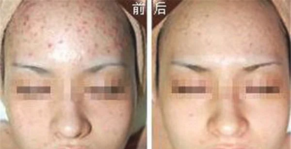 做冷冻治疗去痘疤价格