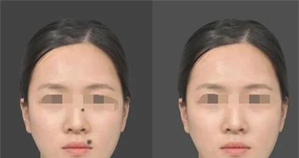做微晶磨削去黑痣治疗效果怎么样？效果保持时间多久？