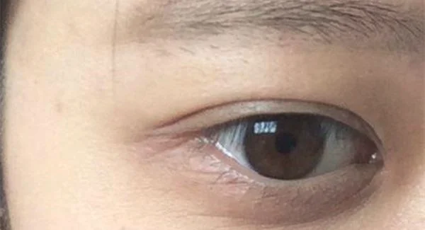 做射频去鱼尾纹手术注意事项是什么？