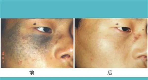 做去太田痣手术多少钱？