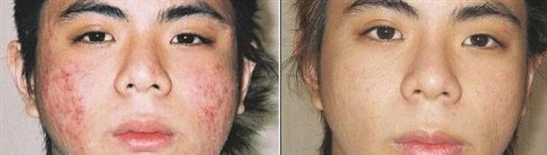 做袪青春痘多少钱