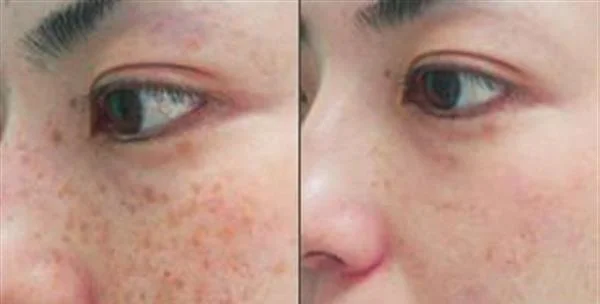 化学剥脱祛斑手术效果好不好?