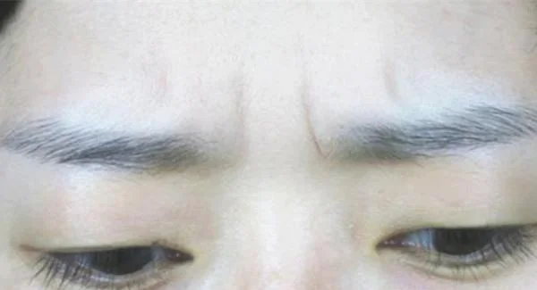 做微晶磨皮去眉间纹手术注意事项是什么？