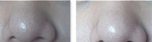 去粉刺手术安全吗？