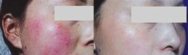 做E光去红血丝治疗效果怎么样？效果保持时间多久？