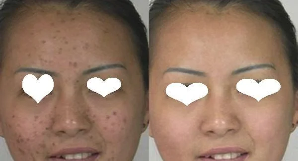 做激光去痘印价格是多少