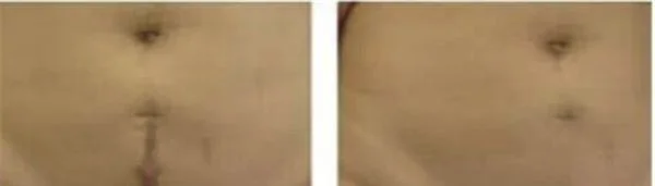 剖腹产疤痕修复效果好不好?