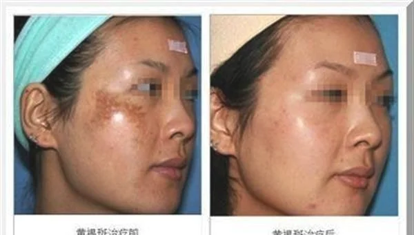 冷冻法去黄褐斑手术的方法是什么？
