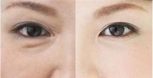 做爱贝芙去眼角细纹多少钱