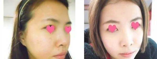 微针嫩肤手术安全吗？