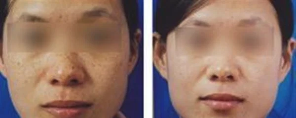 剥脱治疗去雀斑手术注意事项是什么?