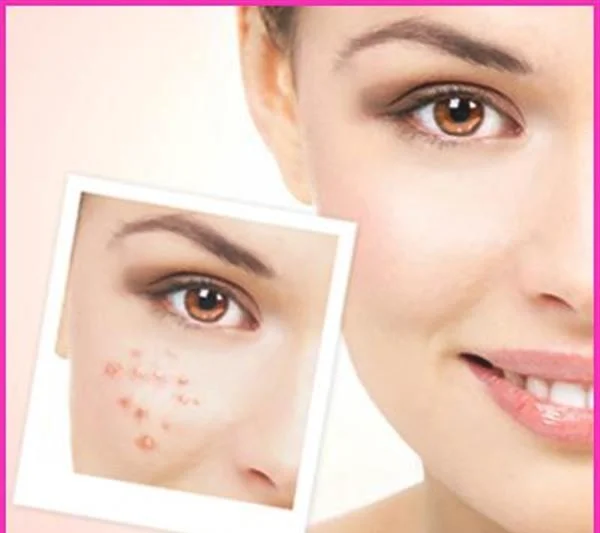 做光子祛痘价格贵不贵