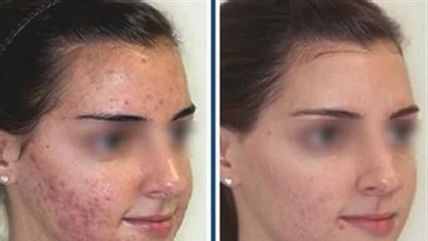 做激光去青春痘价格是多少