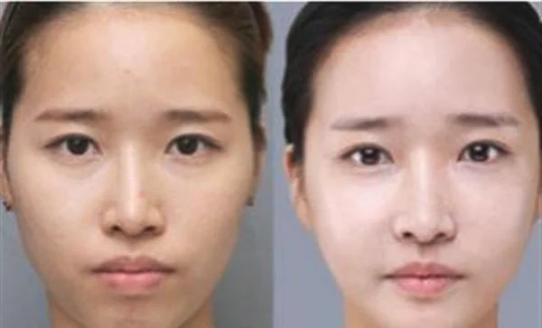 做激光嫩肤费用大概需要多少