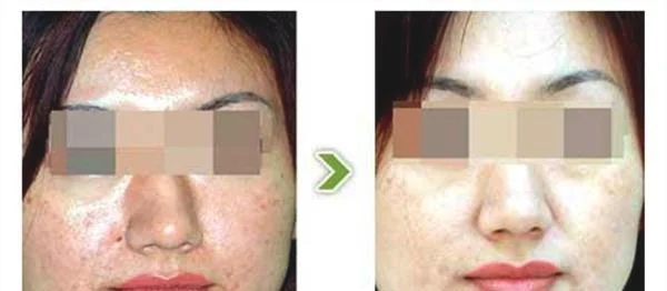 E光美白手术注意事项是什么？