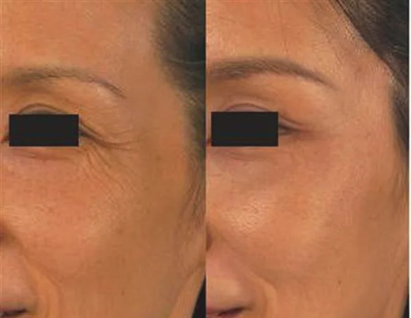 做额颞部除皱去鱼尾纹手术多少钱？