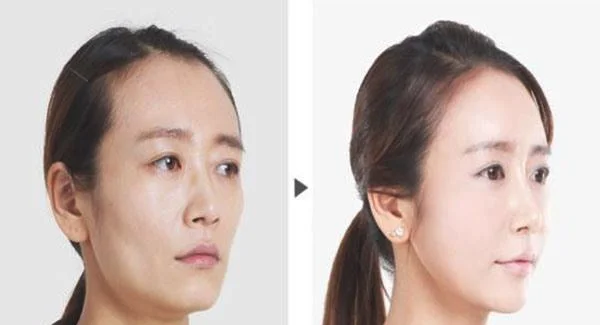 做射频紧肤价格贵吗