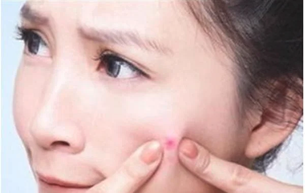 怎样快速祛痘小妙招