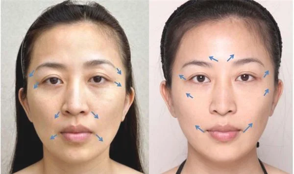 玻尿酸去眼角细纹效果如何？