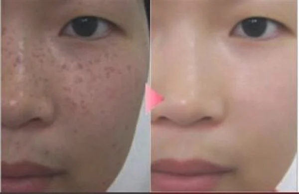 做激光去黄褐斑费用大概需要多少