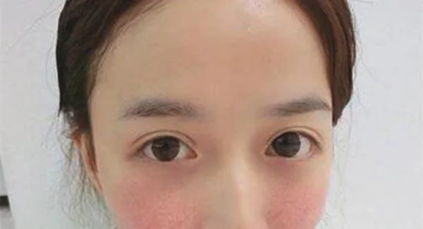 做光子祛红血丝价格是多少