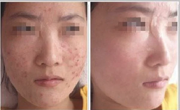 做激光治疗痤疮费用大概需要多少