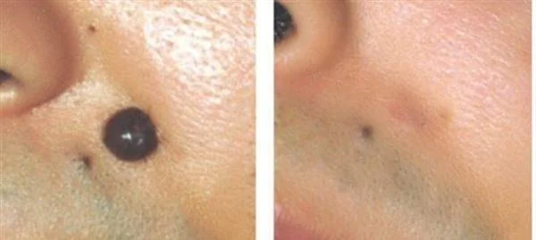 做冷冻去痣费用大概需要多少