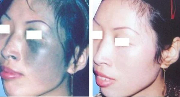 做去太田痣手术时间是多久？