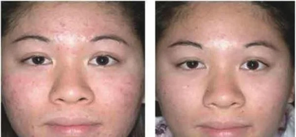 做E光去黄褐斑多少钱