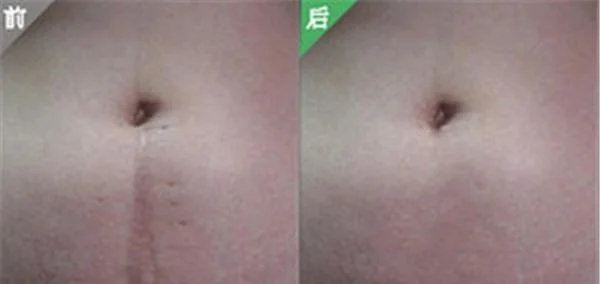 做剖腹产疤痕修复价格