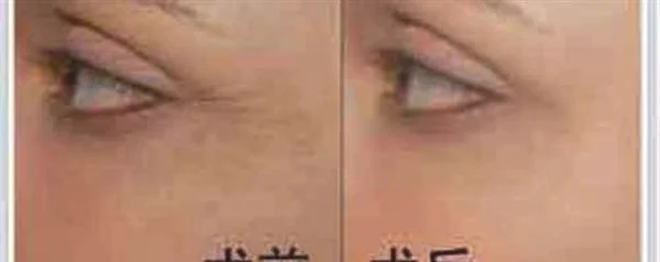 胶原蛋白去鱼尾纹手术术后护理？