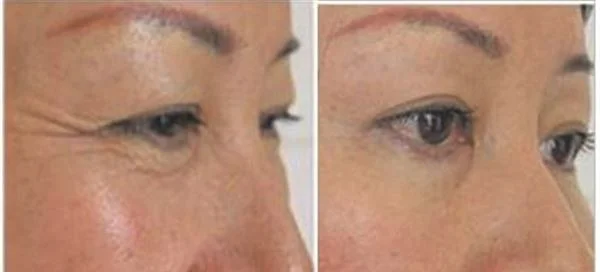 胶原蛋白去鱼尾纹手术注意事项是什么？