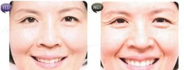 去鱼尾纹失败修复需要注意什么？