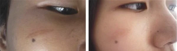 面部疤痕修复恢复需要注意什么？